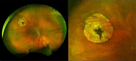 Operculated Retinal Hole In Retinal Detachment Retina