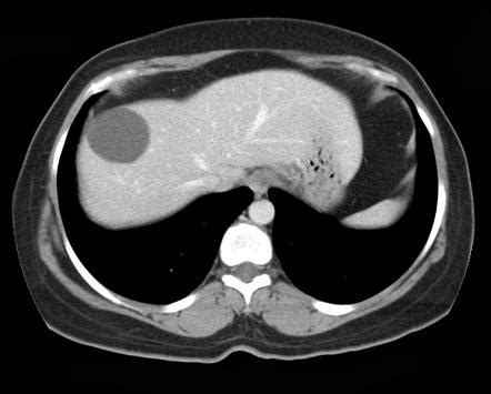 Simple hepatic cyst | Radiology Reference Article | Radiopaedia.org