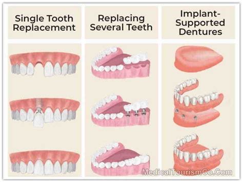 How much does it cost to get a full set of dental implants - Dental News Network