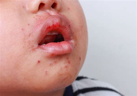 Hand, foot and mouth disease strikes Pittsburgh-area schools | Pittsburgh Post-Gazette