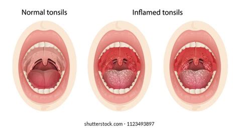 Normal Vs Swollen Tonsil