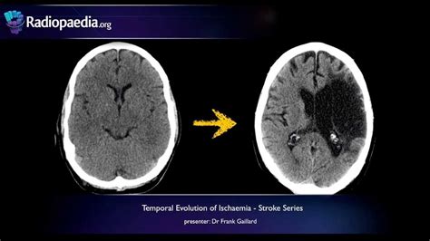 Stroke: Evolution from acute to chronic infarction - radiology video tutorial (CT, MRI ...