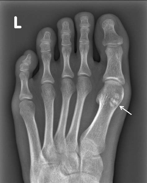 Metatarsal Sesamoid Bone Causes and Treatment - A Little Piece of ...