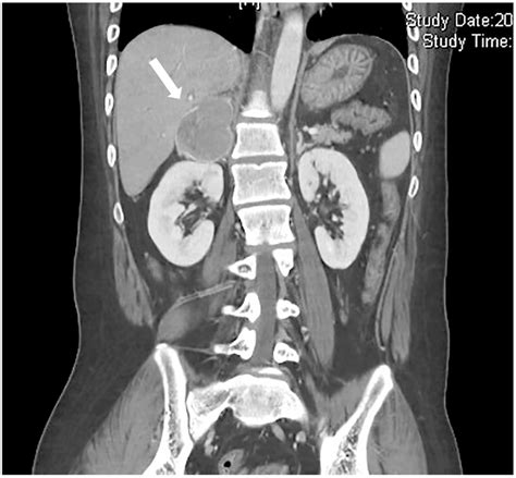 Preoperative imaging showed a 5.5-cm right pheochromocytoma by ...