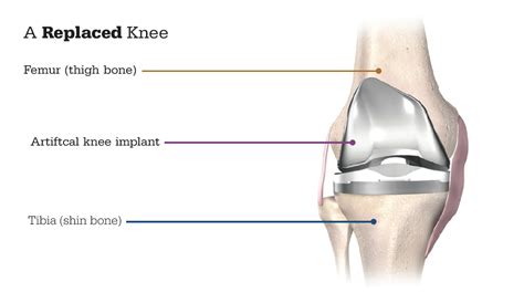 Mako Robotic Total Knee Replacement - Dr Hulse