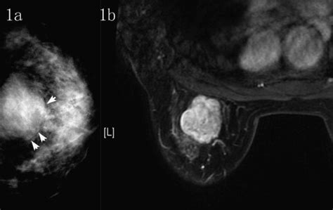 Imaging findings in phyllodes tumors of the breast - European Journal of Radiology