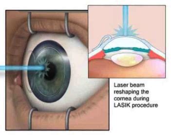 Refractive Surgery| Plessen Ophthalmology