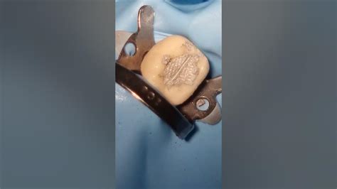 Amalgam Filling Procedure - Step by Step - YouTube