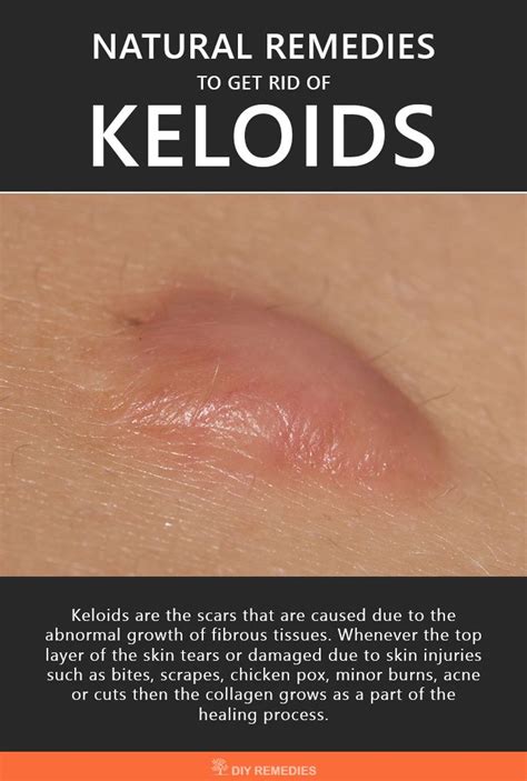 Keloid Scar From Acne