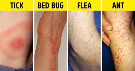 Inspiration. Creativity. Wonder. | Bugs, Bed bug bites, Bug bites