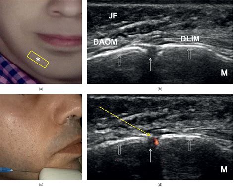 Mental Nerve Block