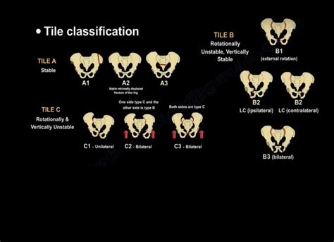 Classification Of Pelvic Fracture