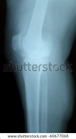 X-Ray Osteoporosis Knee Stock Photo 60677068 : Shutterstock