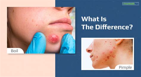 Boil VS Pimple - What Is The Difference? - True Health Tips