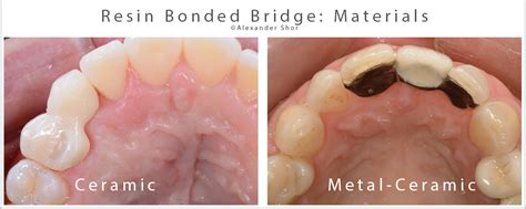 Resin Bonded Bridge: Minimally Invasive Option for Tooth Replacement - Shor Dental