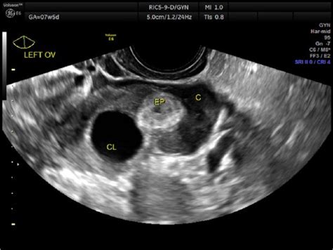 Corpus Luteum Ultrasound