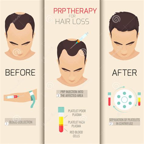 PRP Therapy For Hair Loss