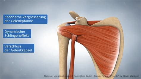 Animation Latarjet procedure - MedicalGraphics