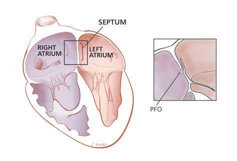 Patent Foramen Ovale | Heart Care | Intermountain Healthcare