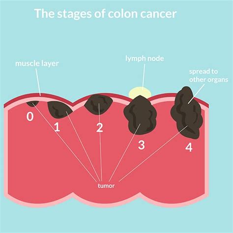 Signs And Symptoms Of Stage 3 Colon Cancer - Bloody Stool Colon Cancer ...