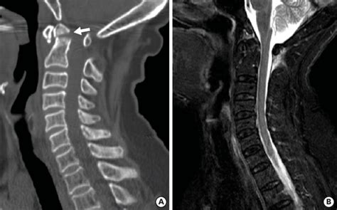 Odontoid Process Fracture