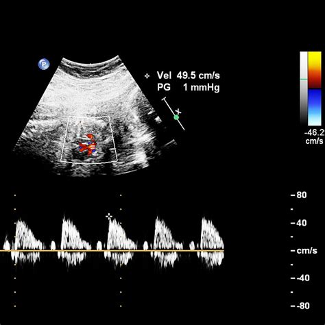 Fetal Echocardiogram - Dr. Steve Rad, OB/GYN