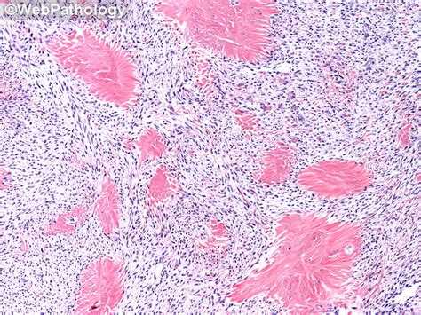 Ovarian Fibroma Histology