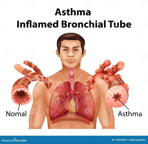 Inflammation Of The Bronchial Tubes