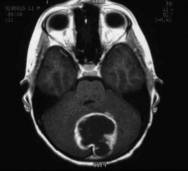 Pediatric Astrocytoma: Background, Pathophysiology, Epidemiology