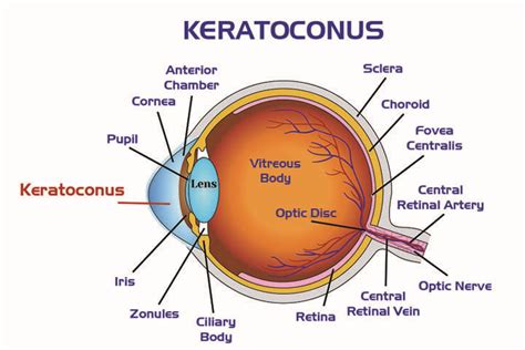 Keratoconus & Scleral Lens Clinic San Diego | ReVision Optometry