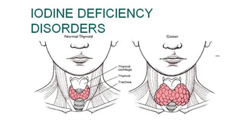 defeciency of iodine - Science - Components of Food - 431919 | Meritnation.com