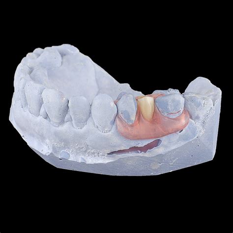 Valplast Partial Dentures, Dental Supply, Dental Crown, Dental Unit ...