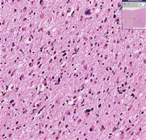 Histopathology Brain--Astrocytoma - YouTube