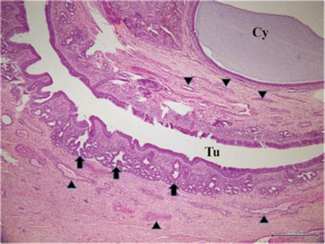 Histology of the nasal tissue-derived hamartoma. The cystic structures... | Download Scientific ...