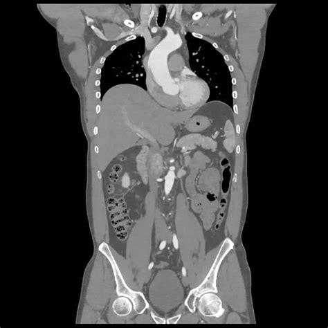 Whole Body CT | Insight Medical Imaging