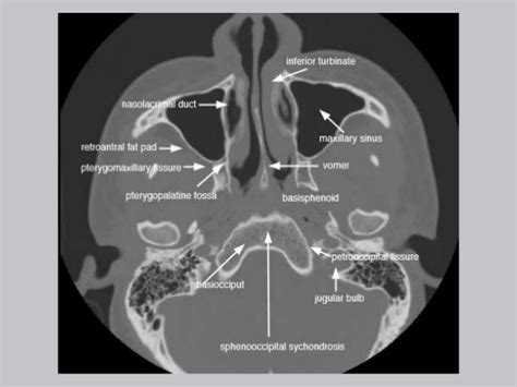 Sphenoid Sinus Ostium Ct - MarhtyuettahtyuiSalas