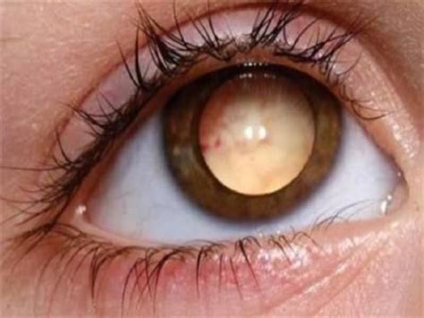 10 Of The Most Bizarre Eyes In The World