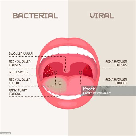 Vetores de Infecção De Garganta Inflamação De Amígdalas e mais imagens ...