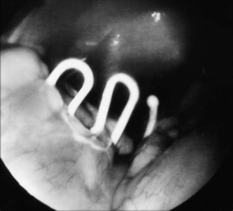 Partially dissected Lippes Loop. | Download Scientific Diagram