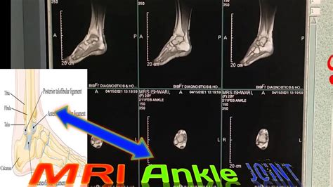 How to Do of Ankle joint MRI planning /Anatomy of Ankle Joint/ Ankle MRI| A2Z medical Guru G ...