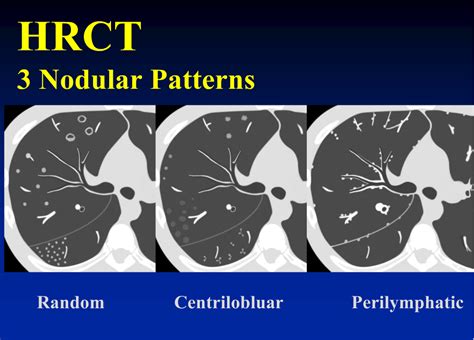 rsna: HRCT pattern based analysis