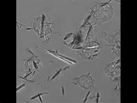 Monosodium Urate Crystals