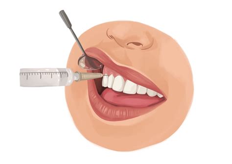 What are the different types of dental anesthesia? | Authority Dental