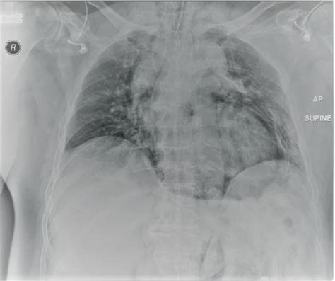 Another Complication of Peroral Endoscopic Myotomy | CTSNet