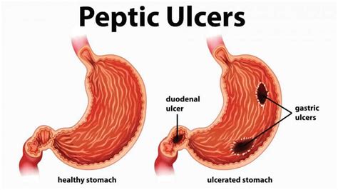 Overuse of these drugs can lead to Peptic Ulcer Disease - rafaMALL