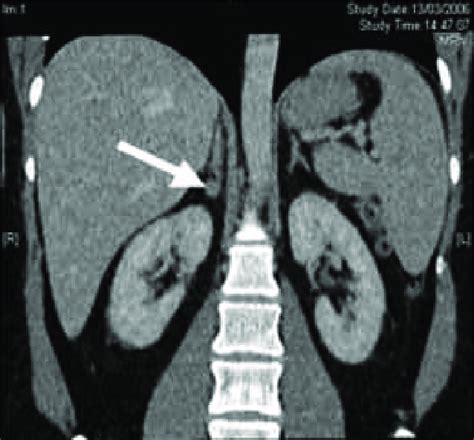 Conn's adenoma in the adrenal gland. MRI scan of patients with high... | Download Scientific Diagram