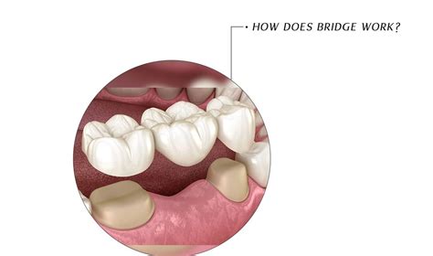 What happens during a dental bridge procedure? - Smile Ready Bali