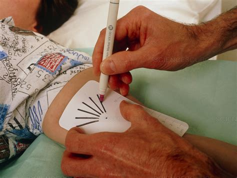 Science Source Stock Photos & Video - Stencil used for contraceptive implants (Norplant)