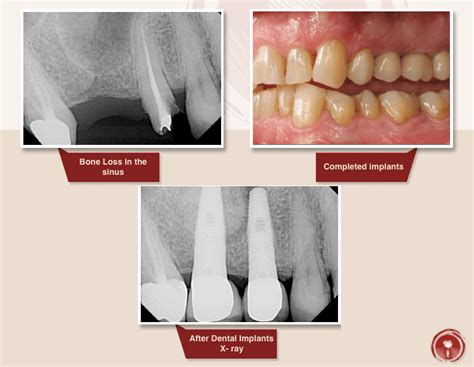 Bone Grafting Smile Gallery: Sinus Lift Bone Graft | Ramsey A. Amin, DDS