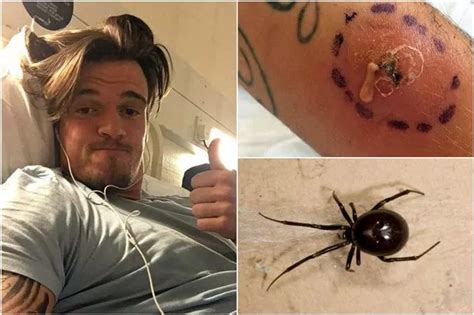 Former Boro youth player suffers horrific injuries after being bitten by a false widow spider ...